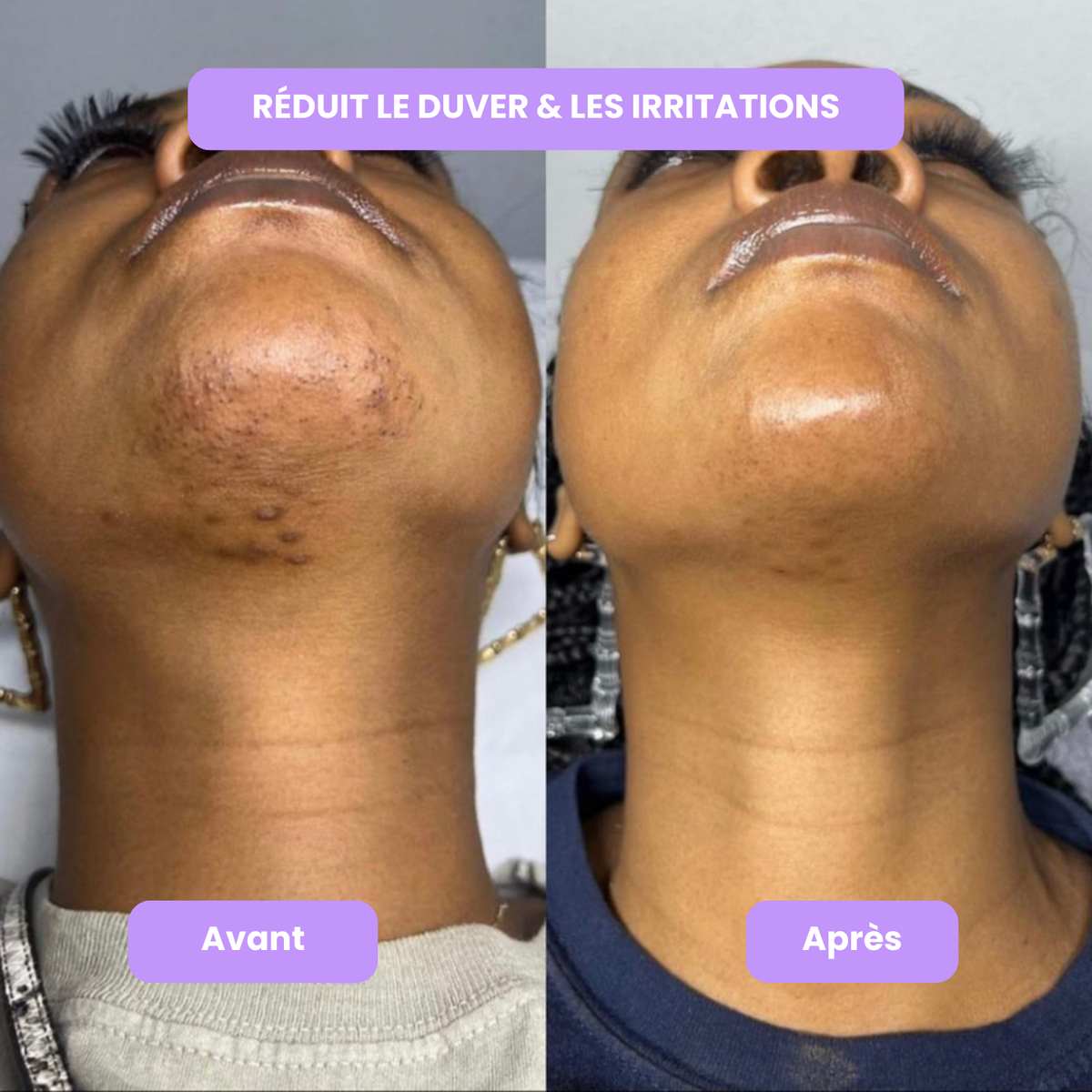 Diacoda - Sérum anti-repousse