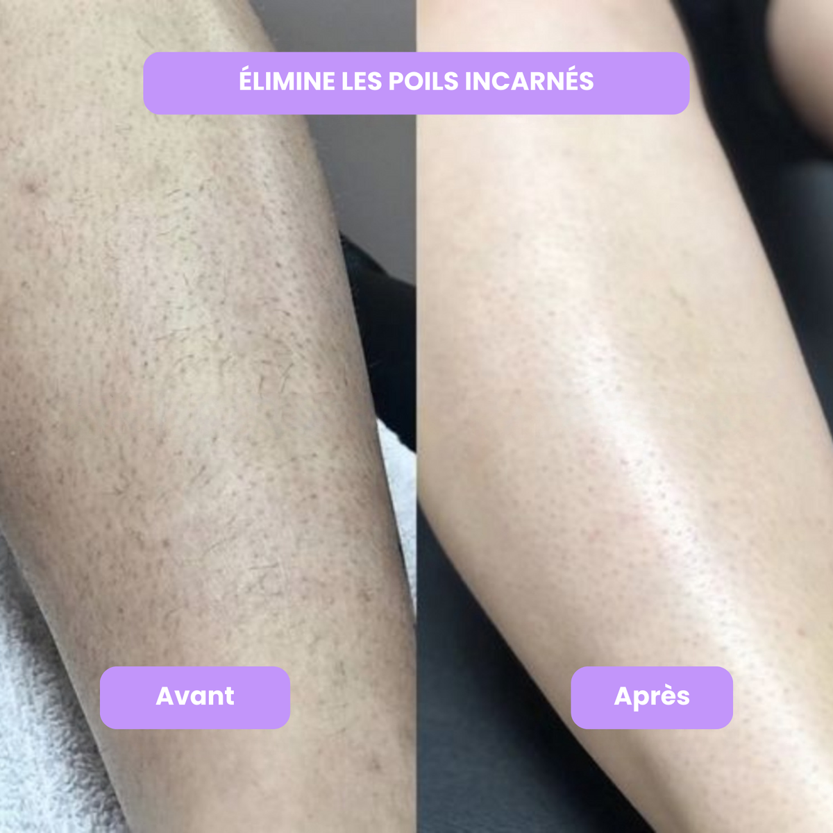 Diacoda - Sérum anti-repousse