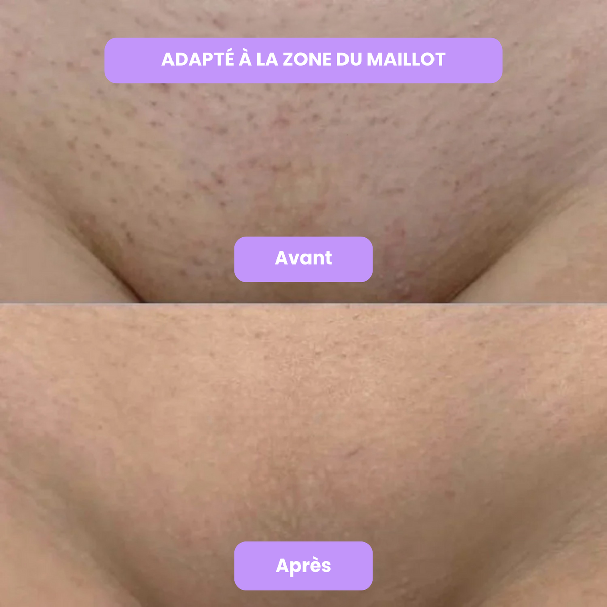 Diacoda - Sérum anti-repousse